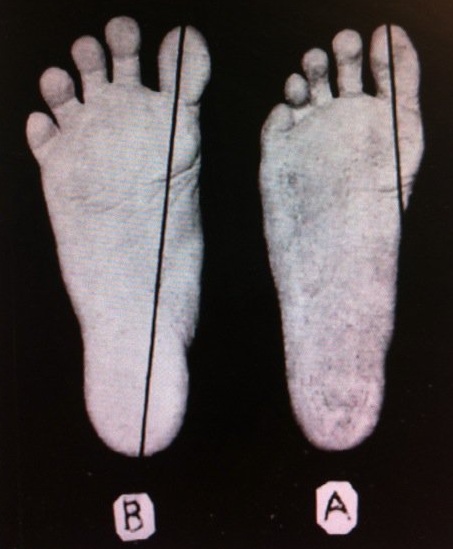 (Left)_(B)_Adult_foot_that_has_never_worn_shoes,_(Right)_(A)_Foot_of_a_boy_who_has_worn_shoes_for_just_a_few_weeks._Plaster_casts